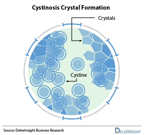 formation-of-crystals-in-cystinosis-disease