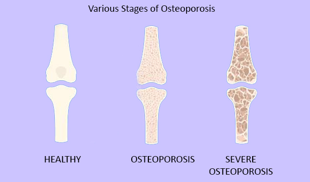 osteoporosis-stages