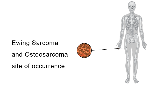 occurrence-site-of-osteosarcoma-and-ewing-sarcoma