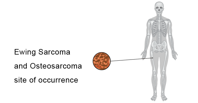 occurrence-site-of-osteosarcoma-and-ewing-sarcoma