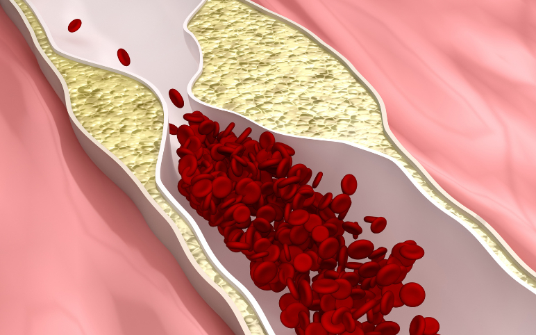 cell-therapies-for-peripheral-artery-disease-treatment