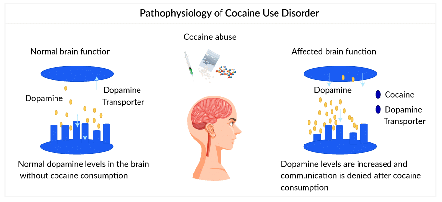 Pathophysiology of Cocaine Use Disorder