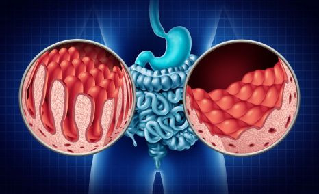 celiac-disease-treatment