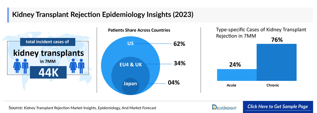 Kidney Transplant Rejection Epidemiology Insights